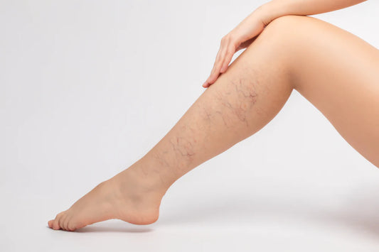 Spider Veins: 5 Natural Remedies and the Lifestyle Framework Behind Them