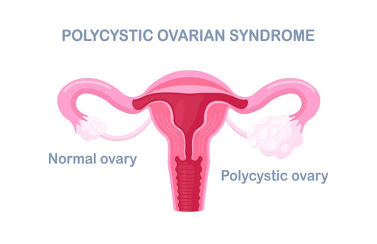 PCOS: The Metabolic Root Cause Nobody Talks About Enough